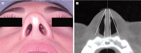 Computed Tomography Technique For Evaluation Of The Nasal Valve JAMA