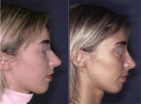 Naso Deviato Younique Rhinoplasty Pietro Palma Md