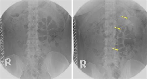 Unilateral renal agenesis – Radiology Cases