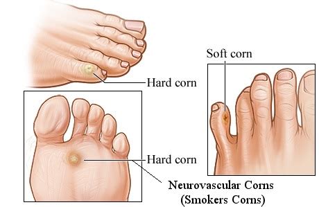 Corns Ankle Foot And Orthotic Centre