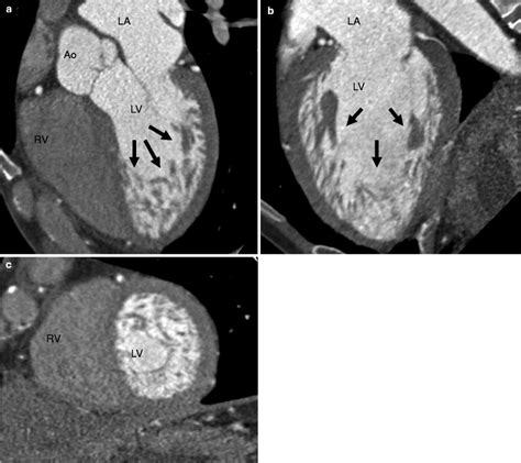 Left Ventricular Noncompaction Lvnc Radiology Key