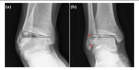 Figure From Anatomic Reconstruction Of Anterior Talofibular Ligament