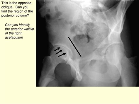 Ppt Lets Look At Some Muscle Anatomy In The Pelvis On Ct Scans