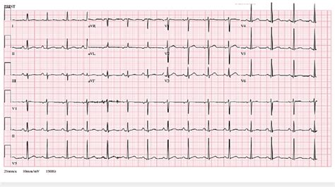 Ecg Ecg Showed Sinus Rhythm Without St Segment Or T Wave Changes