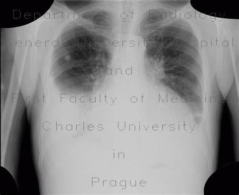 Radiology case: Pericardial effusion after myocardial biopsy