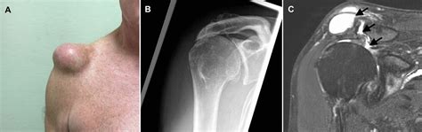 Ganglion Cyst On Shoulder