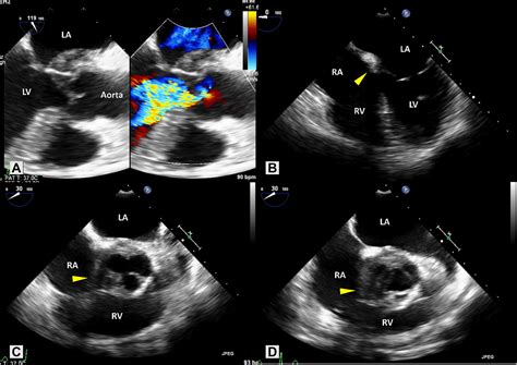 Severe Aortic Valvular Incompetence From Igg4 Related Disease An