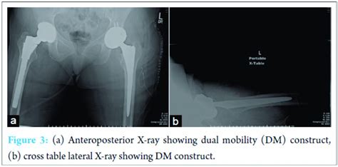 Early Intraprosthetic Dislocation Of A Dual Mobility Acetabular