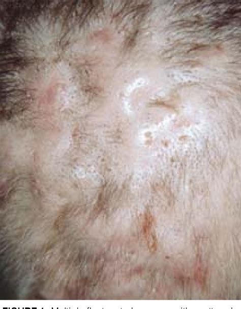 Figure 1 From Dissecting Cellulitis In A White Male A Case Report And Review Of The Literature