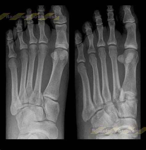 Radiology Archives: Κάταγμα - Εξάρθρημα Lisfranc*