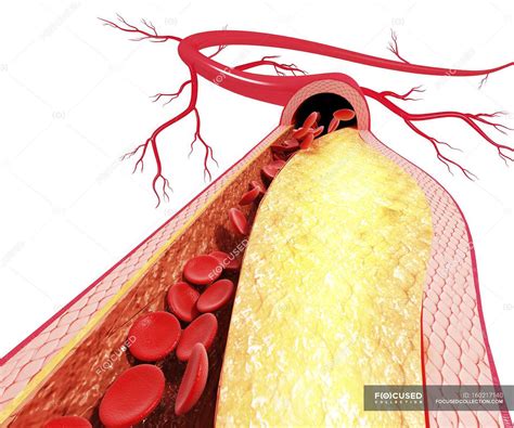 Which Lab Test Is An Indirect Measure Of Atherosclerosis Plaque 4
