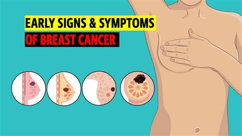 Early Signs And Symptoms Of Breast Cancer YouTube