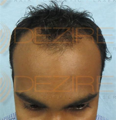 receding hairline natural treatment – Hair Transplant Pune