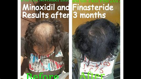 Minoxidil Results