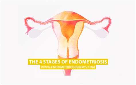 12 Common Places Where Endometriosis Lesions Can Be Found ...