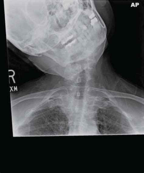 Preoperative Cervical X Ray Demonstrating Severe Right Laterocollis Download Scientific Diagram