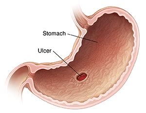 Gastric Ulcers | Saint Luke's Health System