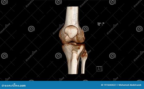 Volume De Tomographie Assistée Par Ordinateur Rendant Lexamen Du