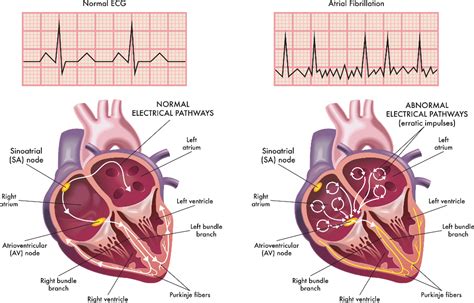 Atrial Fibrillation Causes, Symptoms & Treatment | Dr Raghu