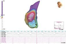 Non Contact Mapping Using The Ensite Array Balloon Catheter A A A