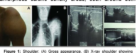 Figure From Ultrasonographic Diagnosis Of Tumoral Calcinosis In End