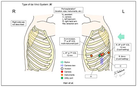 Jpm Free Full Text Port Placement Variations For Robotic Lung