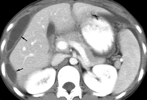 Unusual Causes Of Tubo Ovarian Abscess CT And MR Imaging Findings