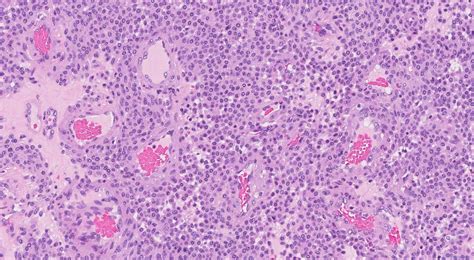 Glomus tumour | Atlas of Pathology