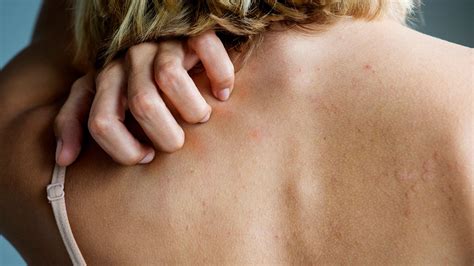 Stress Rash On Neck