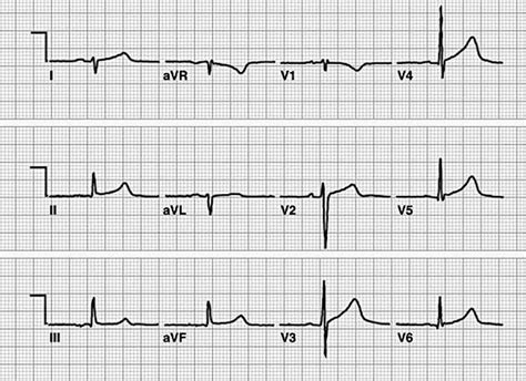 Bundle Branch Blocks And Hemiblocks Ekg Essentials A Student Handbook