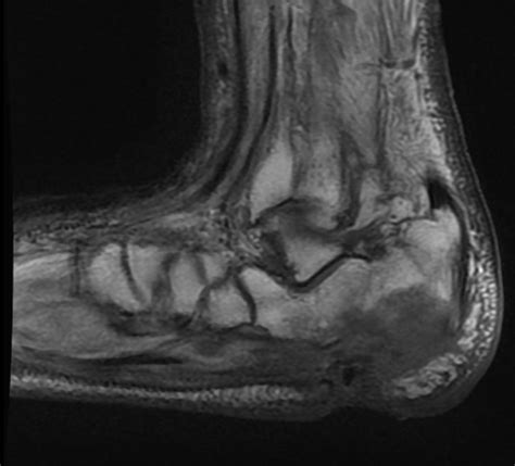 Osteomyelitis Xr