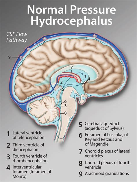 Normal Pressure Hydrocephalus