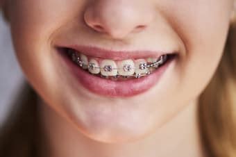 How Do Braces Straighten Your Teeth Coquitlam Orthodontist