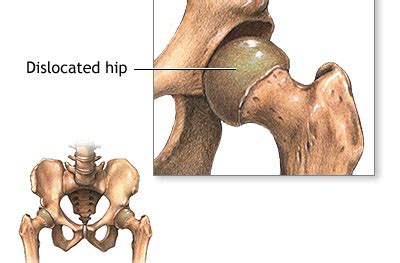 Hip Dysplasia: Symptoms, Causes Treatment, 45% OFF