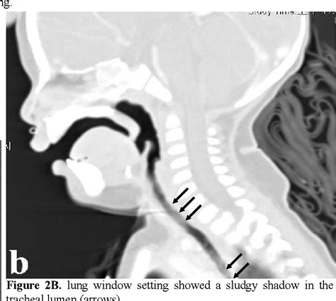 Figure 1 From Bacterial Tracheitis A Case Report Semantic Scholar