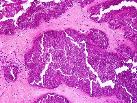 Pathology Outlines Calcium Pyrophosphate Crystal Deposition Disease