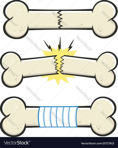 Bone Fracture Line Cartoon Drawing Design Vector Image