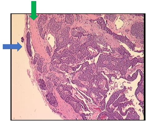 Parathyroid Carcinoma Presenting As Severe Hypercalcaemia Responding To