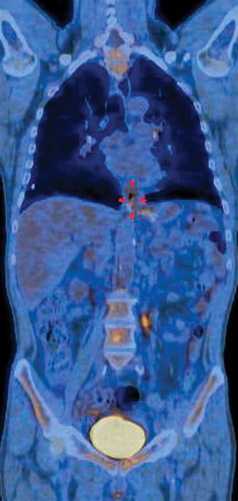 PET CT Of Esophageal Cancer Its Role In Clinical Management