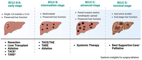 Liver Cancer Stages