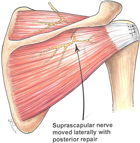 Reversal Of Suprascapular Neuropathy Following Arthroscopic Repair Of