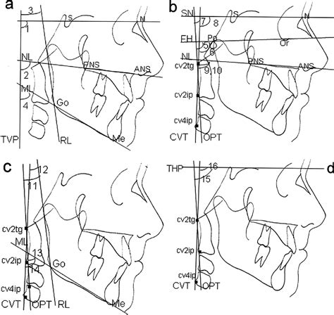 Figure 1 From Head Posture In Cleft Lip And Palate Patients With