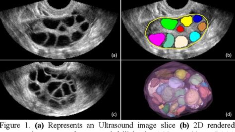 Deep Learning Based Quantification Of Ovary And Follicles Using 3D