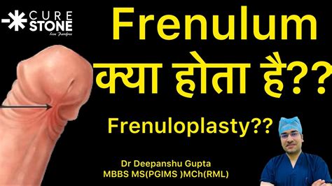 Tight Foreskintight Frenulum फ़्रेनुलोप्लास्टी सर्जरी Ling Ki Tight Chamdi Dr Deepanshu