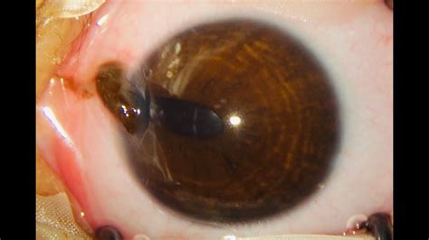 Partial Thickness Corneal Laceration