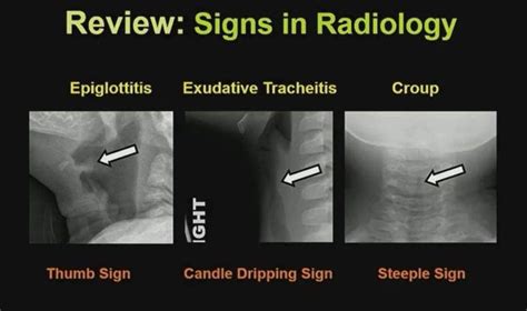 Croup Xray