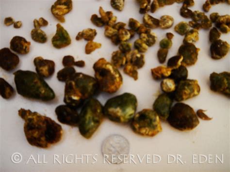 Gallstone Pictures Gallery See Images Of Real Gallstones Passed