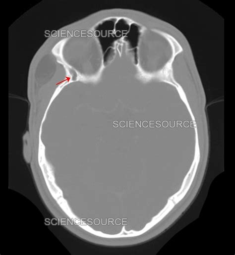 Photograph Congenital Dermoid Cyst Ct Scan Science Source Images