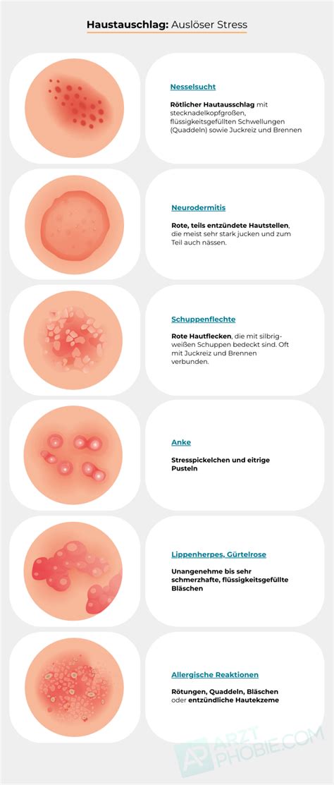 Hautausschlag Durch Stress Was Tun Pickel Durch Stress