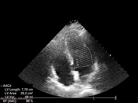 Echocardiogram Vs Ekg What’s The Difference Imagecare Centers